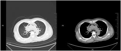 Partial rupture of the left main bronchus with left lung atelectasis due to blunt chest injury: a case report